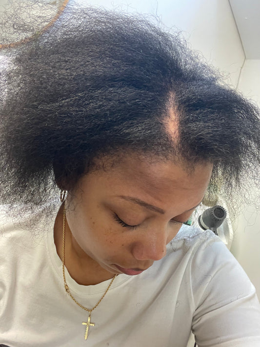 When Hair Loss Becomes Real: Coping With Fear, Grief, and Changes in Confidence